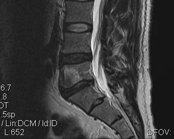 Vertebral Osteomyelitis MRI